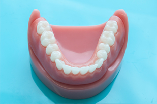 Prothèse sur implant prothese sur implant